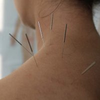 Akupunkturnadeln zur Stimulation der Energiepunkte