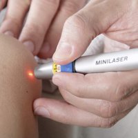 Laserakupunktur: Stimulation von Akupunkturpunkten per Laser